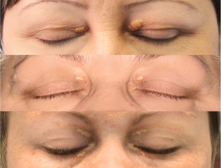 ما هي أعراض ارتفاع الكوليسترول في الجسم؟